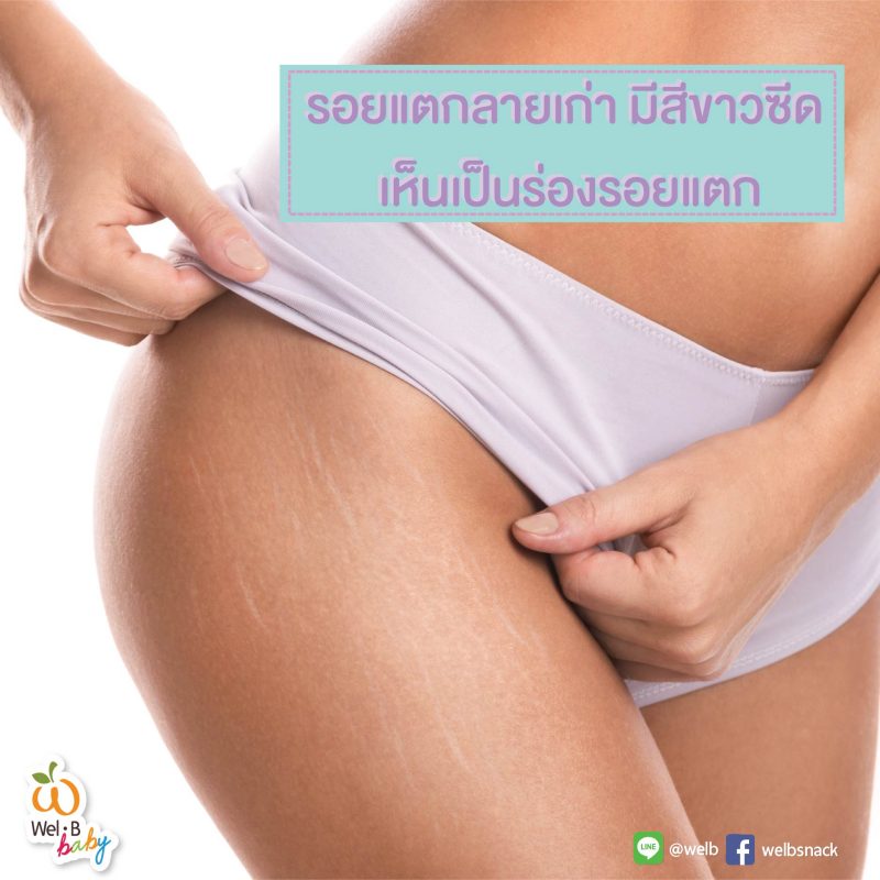 ปัญหาหนักใจ แก้ยังไงกับผิวแตกลายจากการตั้งครรภ์ – WelB Snack ปัญหาหนักใจ แก้ยังไงกับผิวแตกลายจากการตั้งครรภ์ – Welb Snack